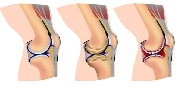 Stages of deformation of the knee joint
