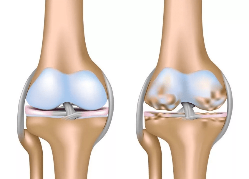Osteoarthritis