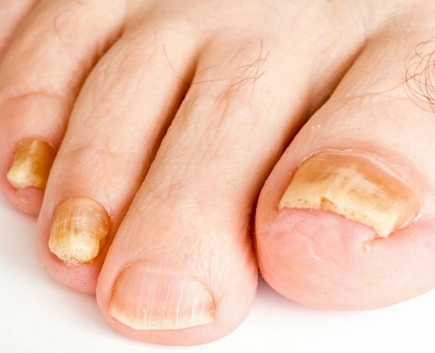 nail fungus