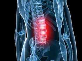 Lumbar column osteochondrosis