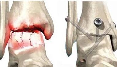 Surgical treatment of knee osteoarthritis