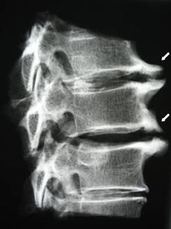Osteophytes of the cervical spine cause neck pain.