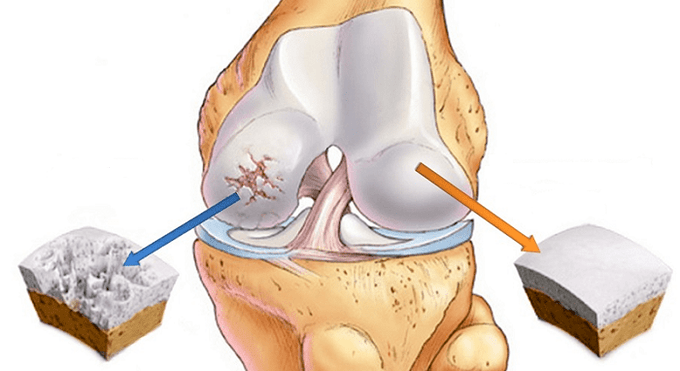 Healthy cartilage and cartilage affected by osteoarthritis.