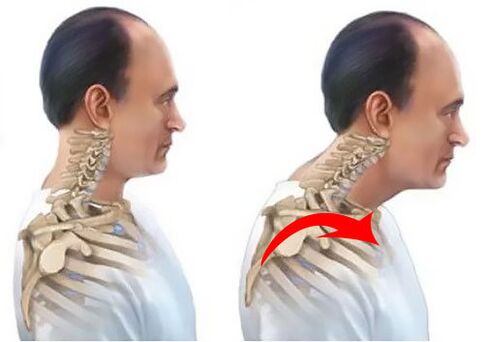 healthy and sick spine