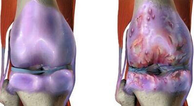 The main differences in arthritis and osteoarthritis