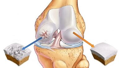 The reasons for the development of arthrosis of the joints