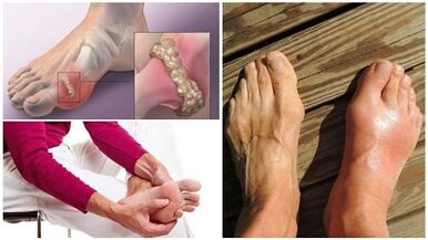 What is arthritis of the joints